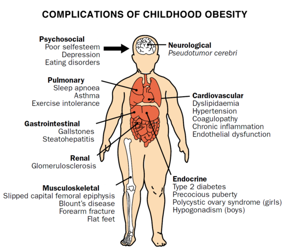 Childhood overwieght and medical complications in Children. Obesity in Adult and how to prevent it.