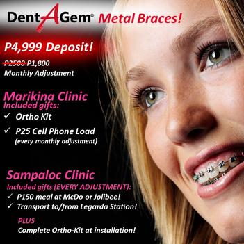 Dental Braces Deals Incl P5000 Sm Shopping Spree Choose The Price You Can Afford Orthodontics Gentle Affordable Dentist Marikina Katipunan Cubao Pasig Quezon City Metro Manila Orthodontics Dentistry