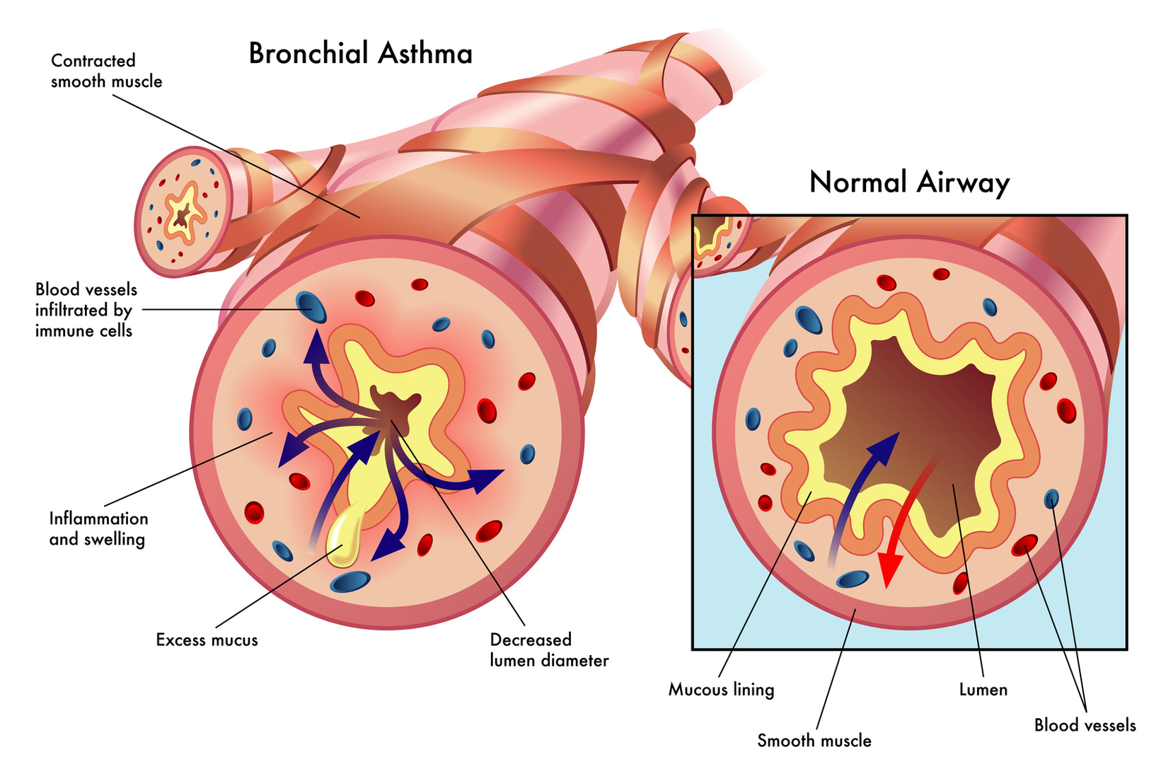 Bronchial asthma