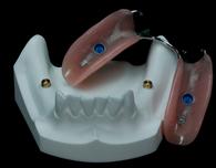 prothèse partielle sur implants Brossard-Laprairie,partial denture on implants Brossard-Laprairie