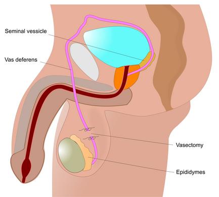 vasectomy stitches