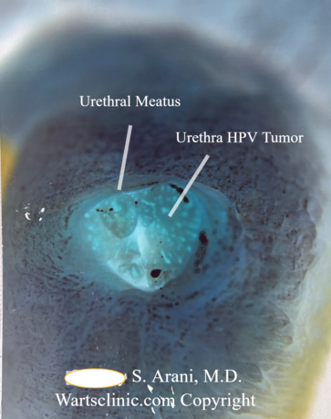 Urethral HPV, Urethra warts, penile hole wart, wartsclinic.com