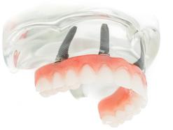 Prothèse Fix-on-4 Clinique Implantologie Dentaire Brossard-LaPrairie
