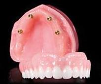 Prothèse Sur Implants Clinique Implantologie Dentaire