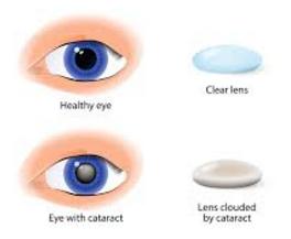 cataract surgery in mumbai bandra west