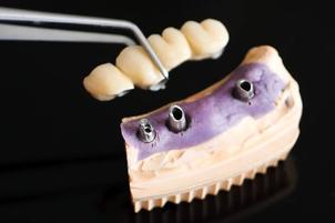 Bridge on dental implants Brossard-Laprairie