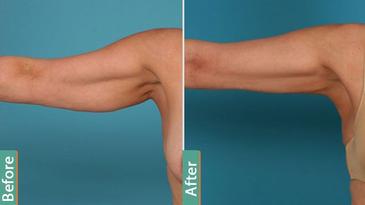 Liposuction Smart ARMS and TRICEPTS