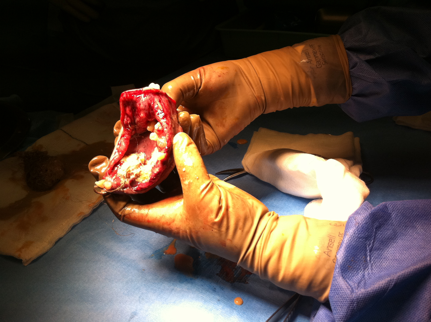 ovarian cyst with hair and teeth