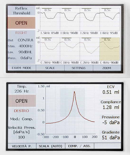 A diagram for plotting findings for tympanometry and acoustic