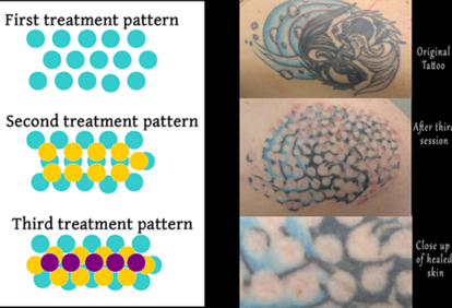 Tattoo Removal Process >> Non Laser Tattoo Removal Tatt2away Tattoo Removal Process >> Non Laser Tattoo Removal Tatt2away