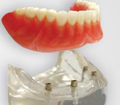 "Dental complete lower denture on 4 dental implants Brossard-Laprairie