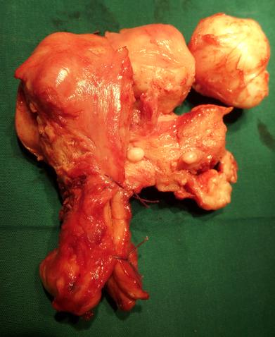 best uterus removal surgeon goa