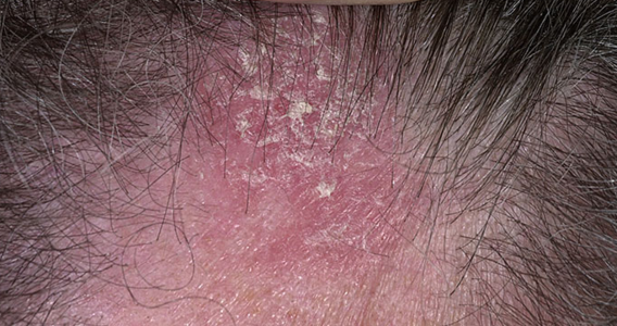 Seborrheic Dermatitis - Dr. Joel Wallach