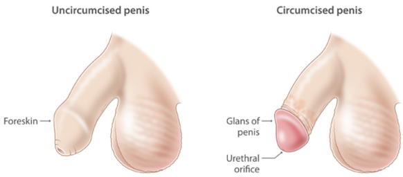 Adult Circumcision: What to Expect at Home