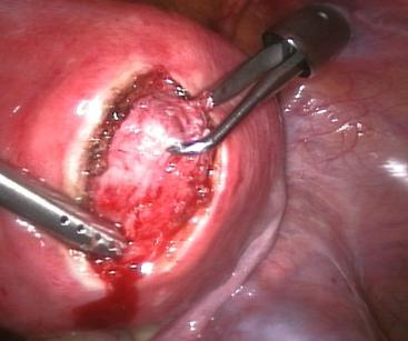 fibroid removal surgery goa