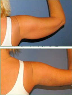 Arm Liposuction Bruising