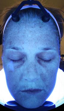 HydraFacial MD - Before