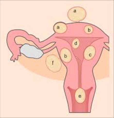 fibroid doctor goa