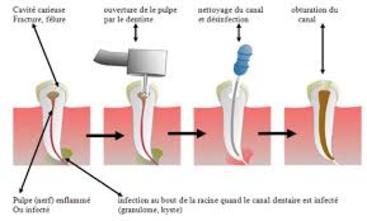 Traitement de Canal Centre Dentaire Chambly