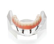 prothèse fixe sur implants Brossard-Laprairie, fixed denture on implants Brossard-Laprairie
