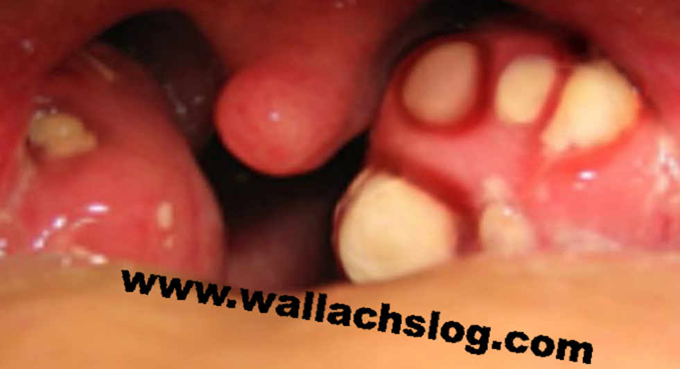 Tonsil Stones - Dr. Joel Wallach