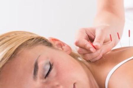 woman laying on right cheek as acupuncturist inserts needles into her back