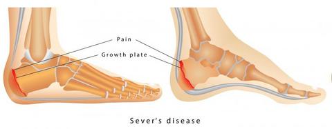 Causes of heel pain in child sale