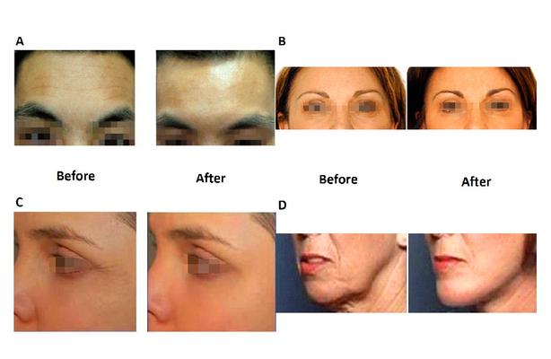 Which Facial Rejuvenation System Is Perfect for Your Practice