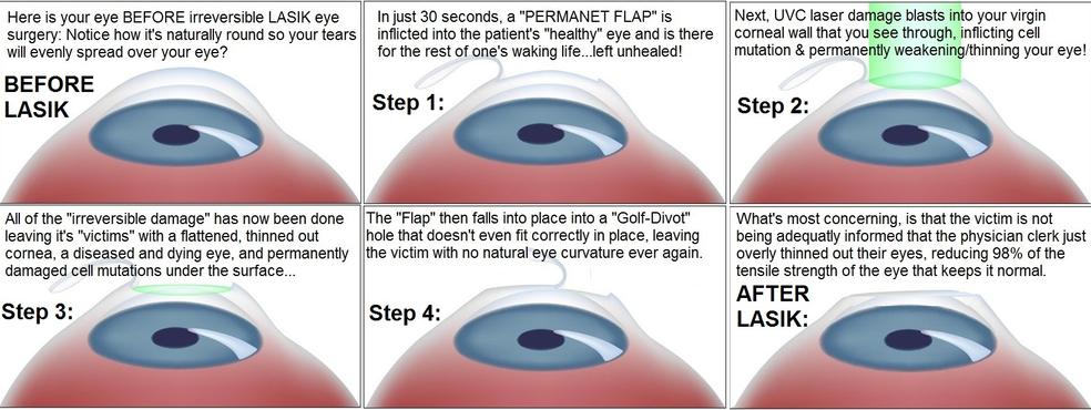 Lasik permanent 2024