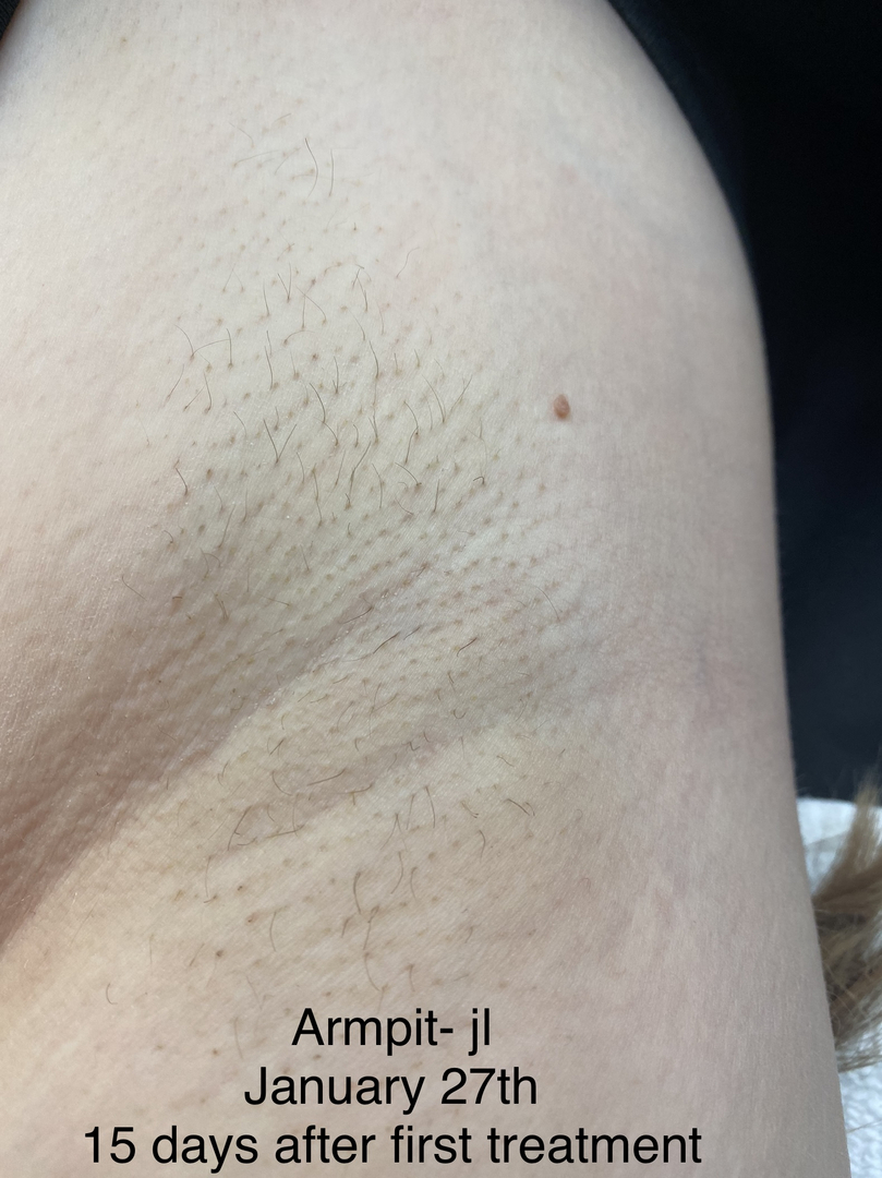 Permanent Hair Removal