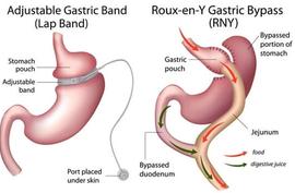 Revision of previous bariatric surgery