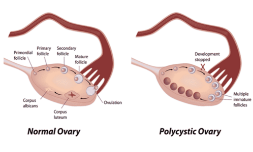 Ovaires polykystiques SOPK et infertilité
