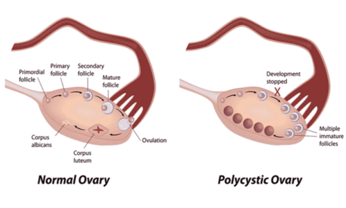 Syndrome des ovaire polykystiques (SOPK) – Gyneco-FIV