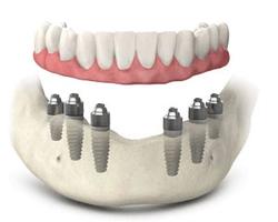 Denture Fix-On-6 Clinique Implantologie Dentaire Brossard-LaPrairie