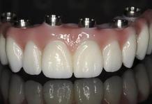prothèse fixe fix-on-zircon Brossard-Laprairie, fixed denture fix-on-zircon Brossard-Laprairie