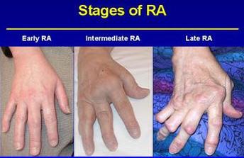 arthritis hands early signs