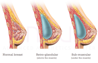 breast implant placement above and under the muscle