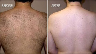 brazilian waxing photos before and after