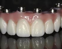 Prothèse Fixe Sur Implants Fix-On-Zircon Fixed Denture On Implants Fix-On-Zircon Brossard-Laprairie