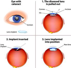 cataract surgery procedure