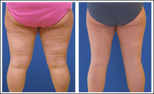 liposuction thigh calves liposculpture cost thighs