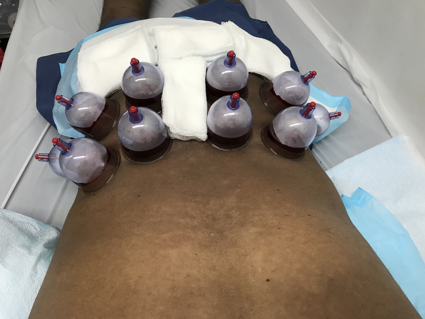 Alhijamah Therapy Clinic / Hijama New York