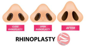Rhinoplasty FAQ