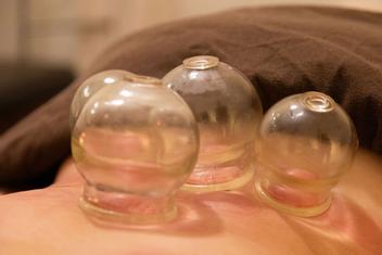Client getting an Asian fire cupping service on a massage table with a massage therapist