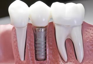 Couronne Sur Implant Centre Dentaire Chambly