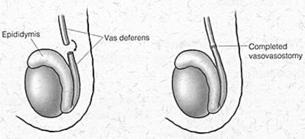 Vasovasotomy