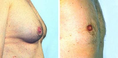 Can Laser Lipo Reduce the Size of My Breasts?: Lori C. Scott, MD: Addiction  Medicine