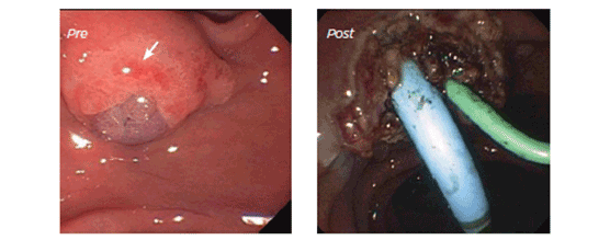 Endoscopy Ampullectomy