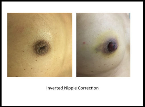 How to Treat an Inverted Nipple Without Surgery
