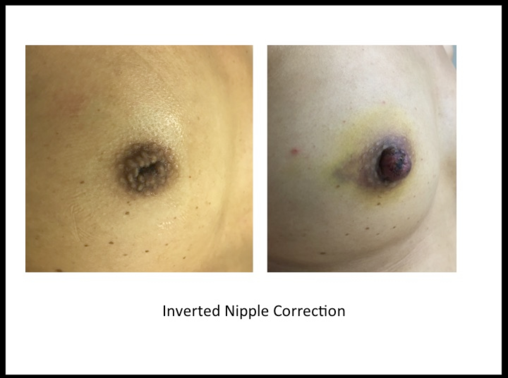 Inverted Nipple Correction near me by Dr Amiti Shah